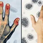 Side-by-side comparison of arthritic and healthy hands highlighting inflammation and pain points
