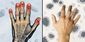 Side-by-side comparison of arthritic and healthy hands highlighting inflammation and pain points